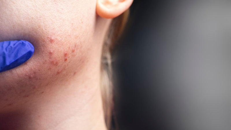 Skin Conditions - Living with Acne